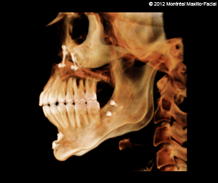 Marie-Hélène Cyr - 3D scan (left profile) after orthodontic treatments and orthognathic surgeries (February 13, 2012)